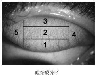 軟性接觸鏡臨床試驗(yàn)指導(dǎo)原則(2018年第51號(hào))(圖2) 軟性接觸鏡臨床試驗(yàn)指導(dǎo)原則(2018年第51號(hào))(圖2)