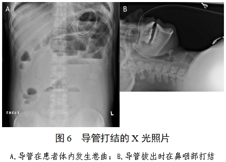 經(jīng)鼻腸營(yíng)養(yǎng)導(dǎo)管注冊(cè)審查指導(dǎo)原則(2022年第41號(hào))(圖5) 經(jīng)鼻腸營(yíng)養(yǎng)導(dǎo)管注冊(cè)審查指導(dǎo)原則(2022年第41號(hào))(圖5)